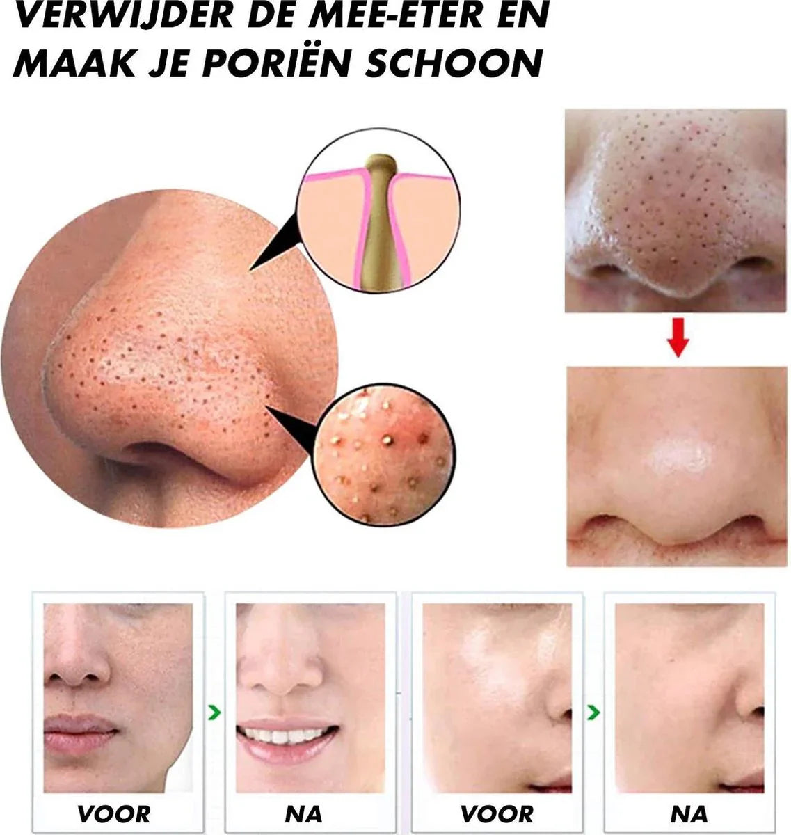 BowLift | Electric Blackhead Remover