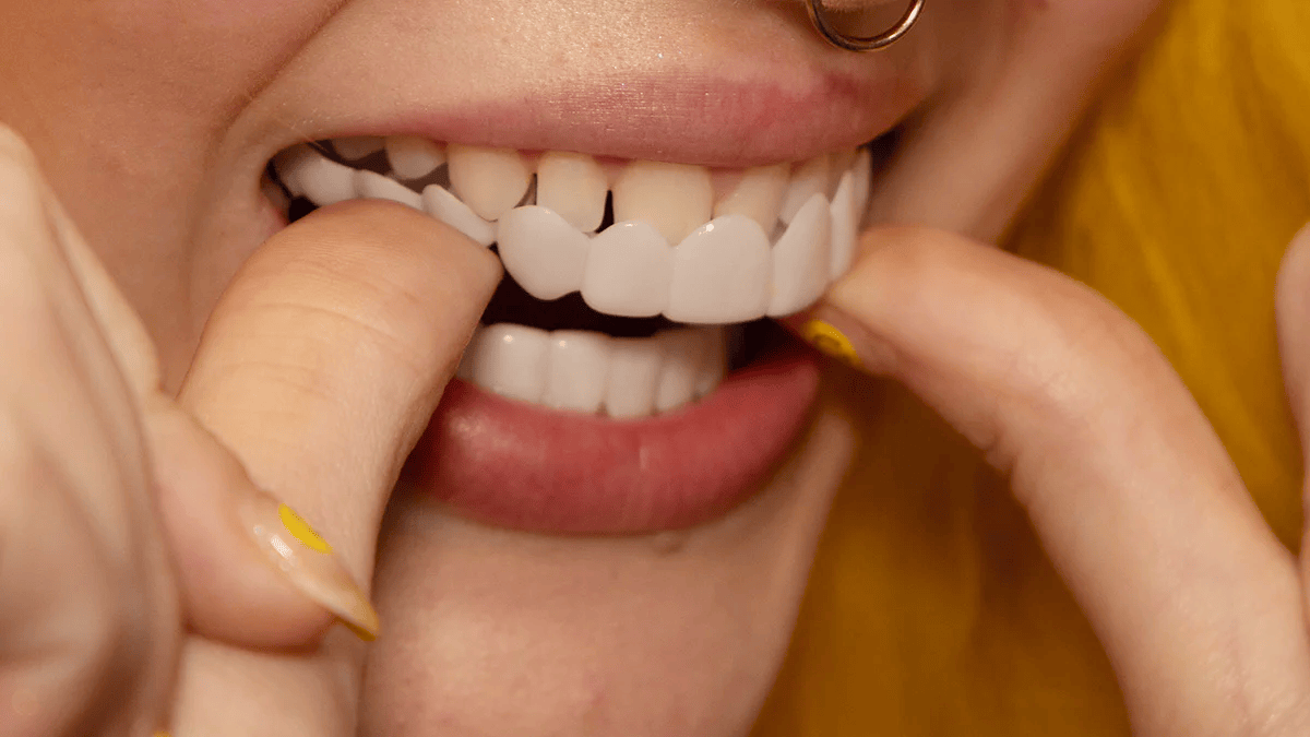 BowLift | Instant Smile Transformation with Snap on Smile Veneers