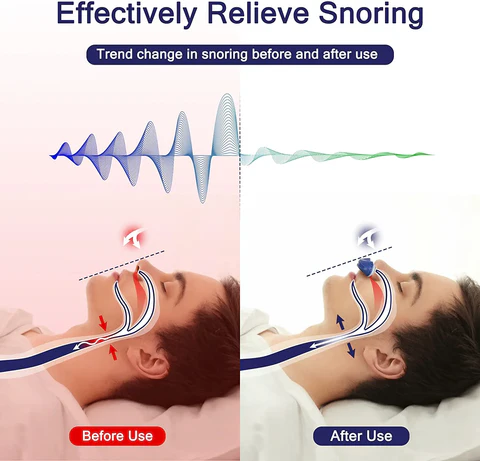 BowLift | Micro CPAP Sleep Apnea Machine for Travel & Anti-Snoring - CPAP Alternative