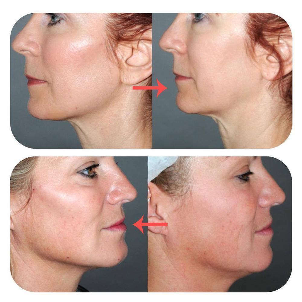 BowLift | Hirundo Face Lifting Patch Invisible Artifact Sticker