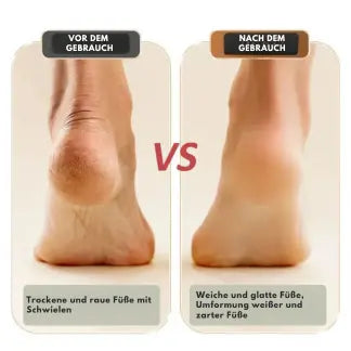 BowLift | Electric Callus Remover