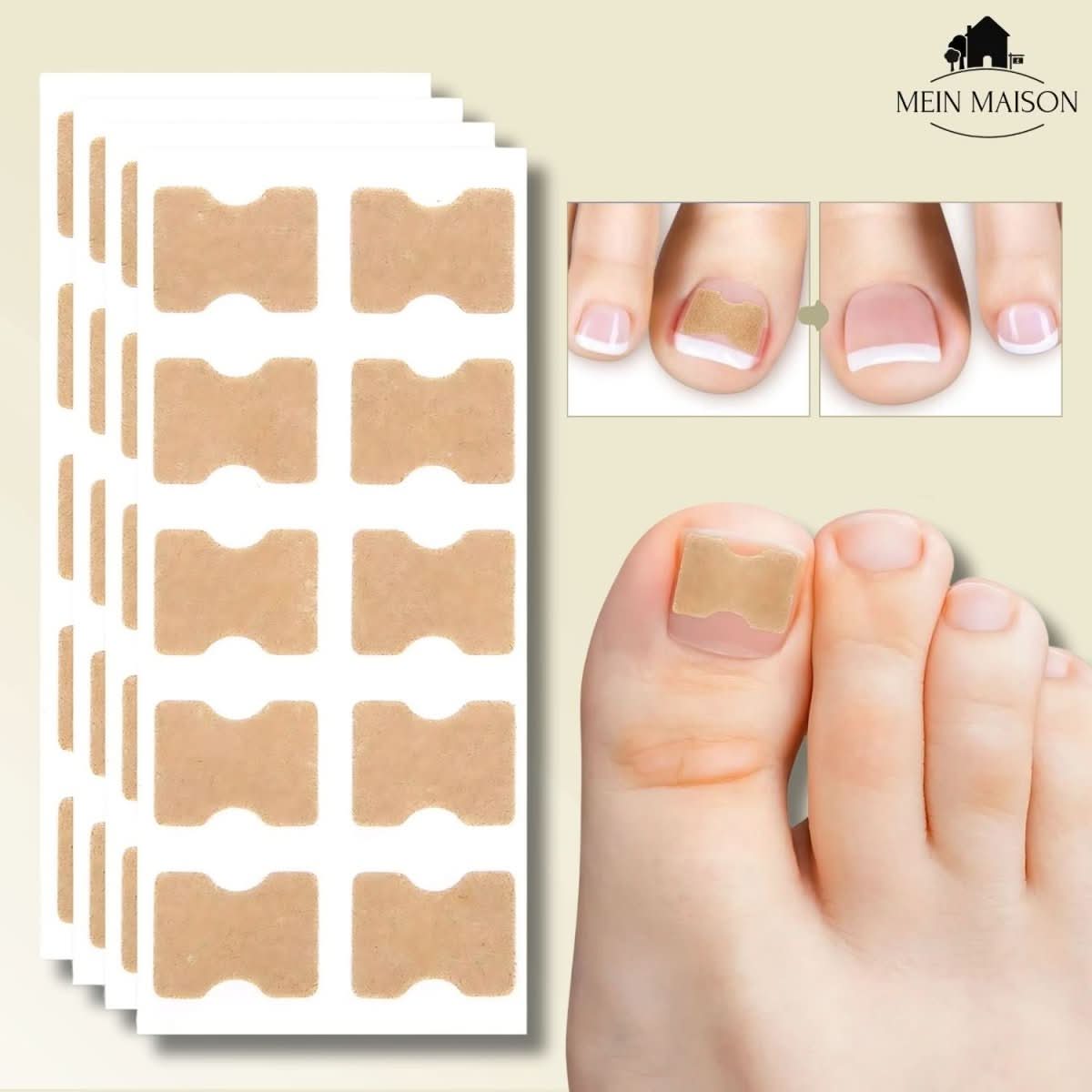 BowLift | FixaNail – Painless nail correction for ingrown & deformed nails