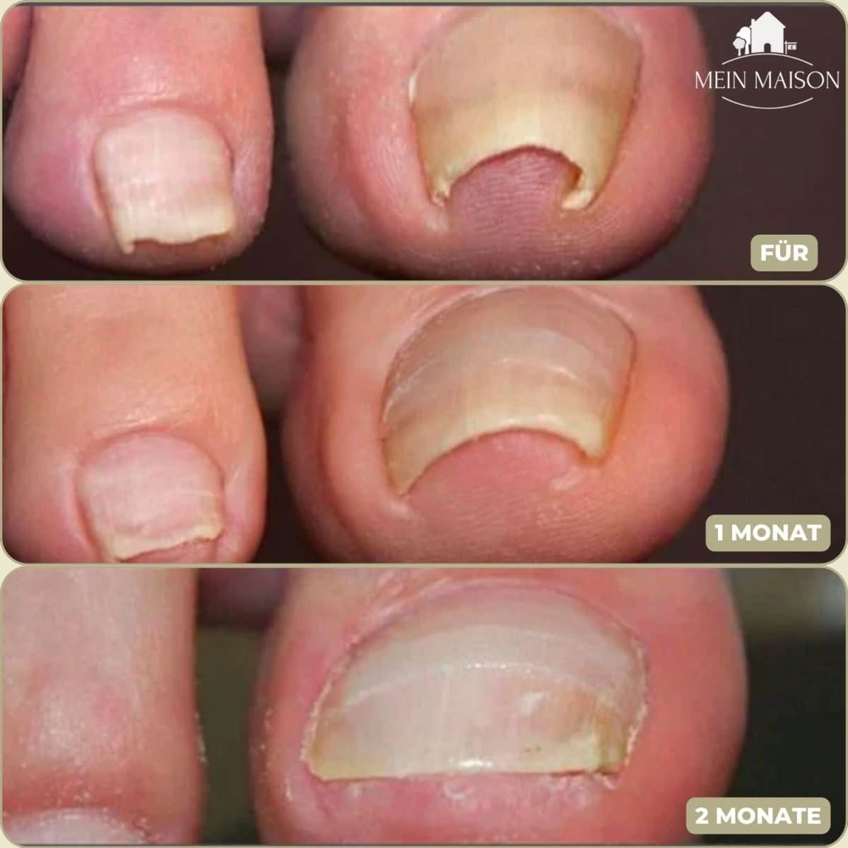 BowLift | FixaNail – Painless nail correction for ingrown & deformed nails