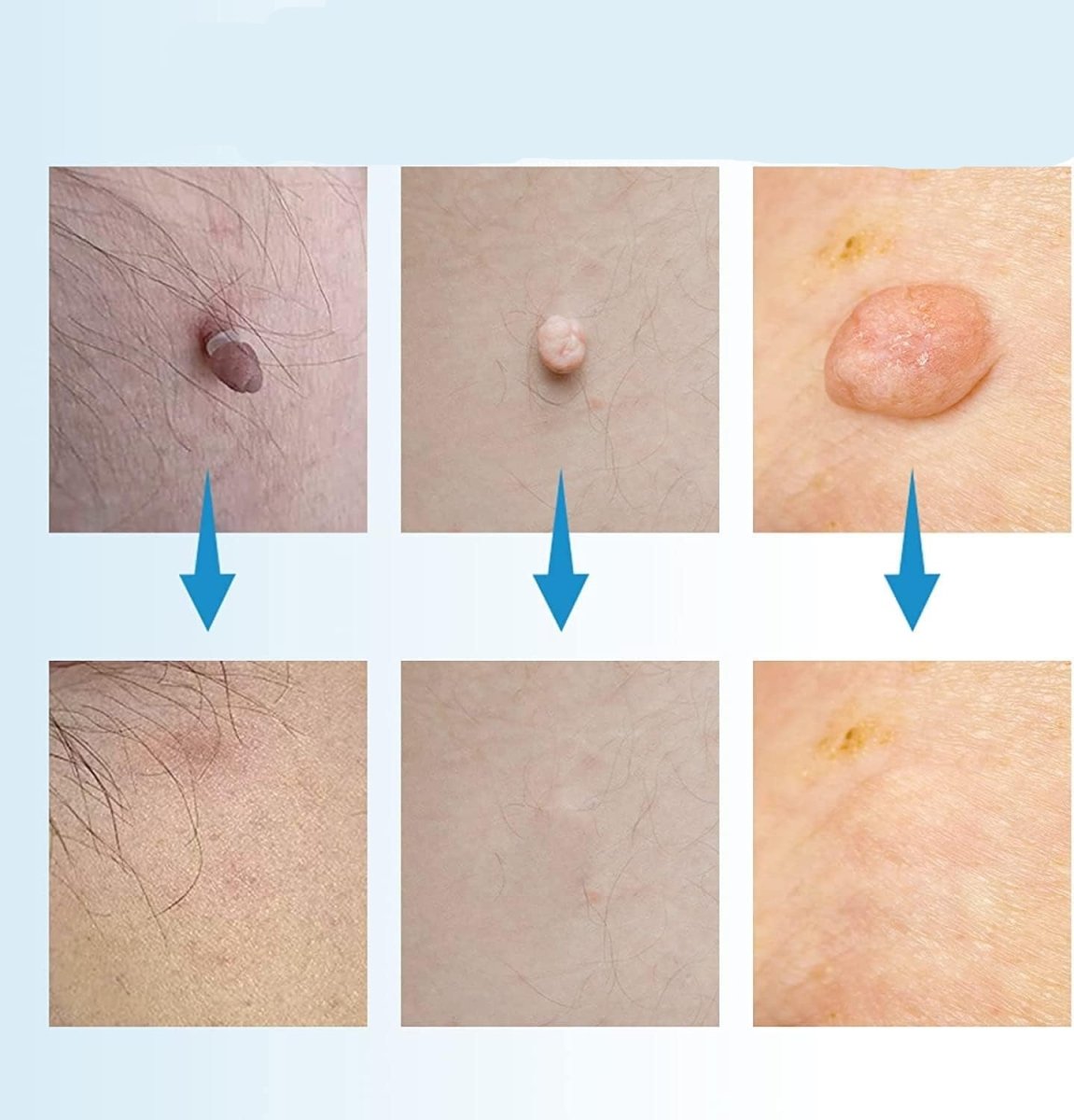 BowLift | EPICLEAR – At-Home Skin Tag & Wart Remover Kit