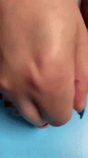 BowLift | Flexible Orthopaedic Bunion Corrector