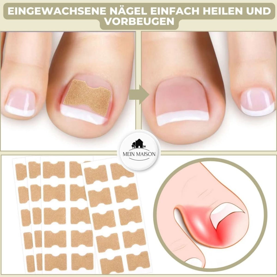 BowLift | Gentle nail correction against ingrown nails & pain