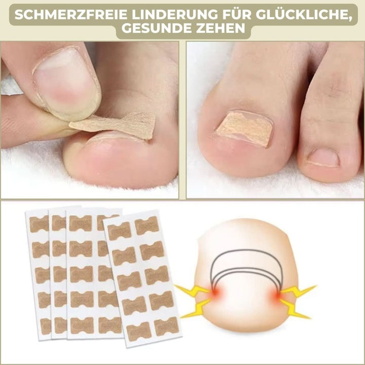BowLift | Gentle nail correction against ingrown nails & pain