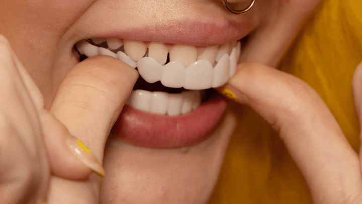 BowLift | Instant Smile Transformation with Snap on Smile Veneers