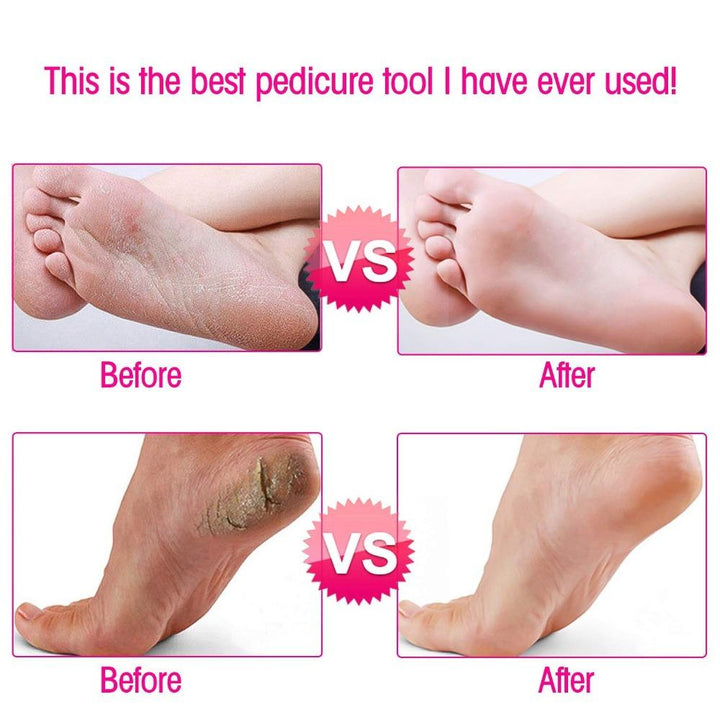 BowLift | Callus Remover - Foot Callus Remover