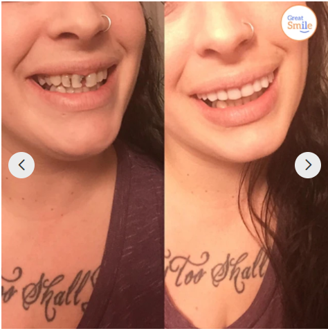 BowLift | Click-In Dental Prosthesis | 1+1 FREE!