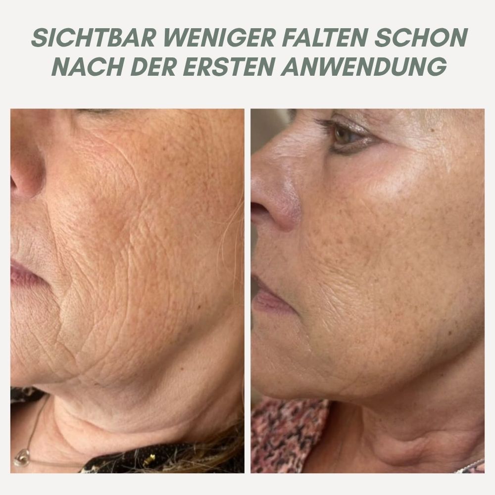 BowLift | YouthMorph — Tight skin in minutes for your youthful WOW moment