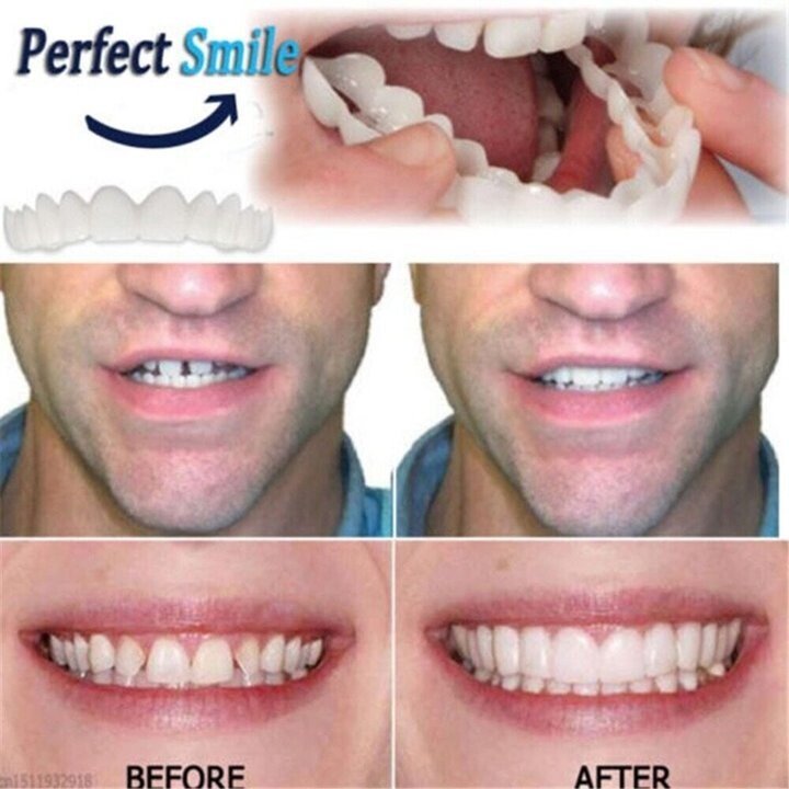 BowLift | Adjustable Snap-On Dentures
