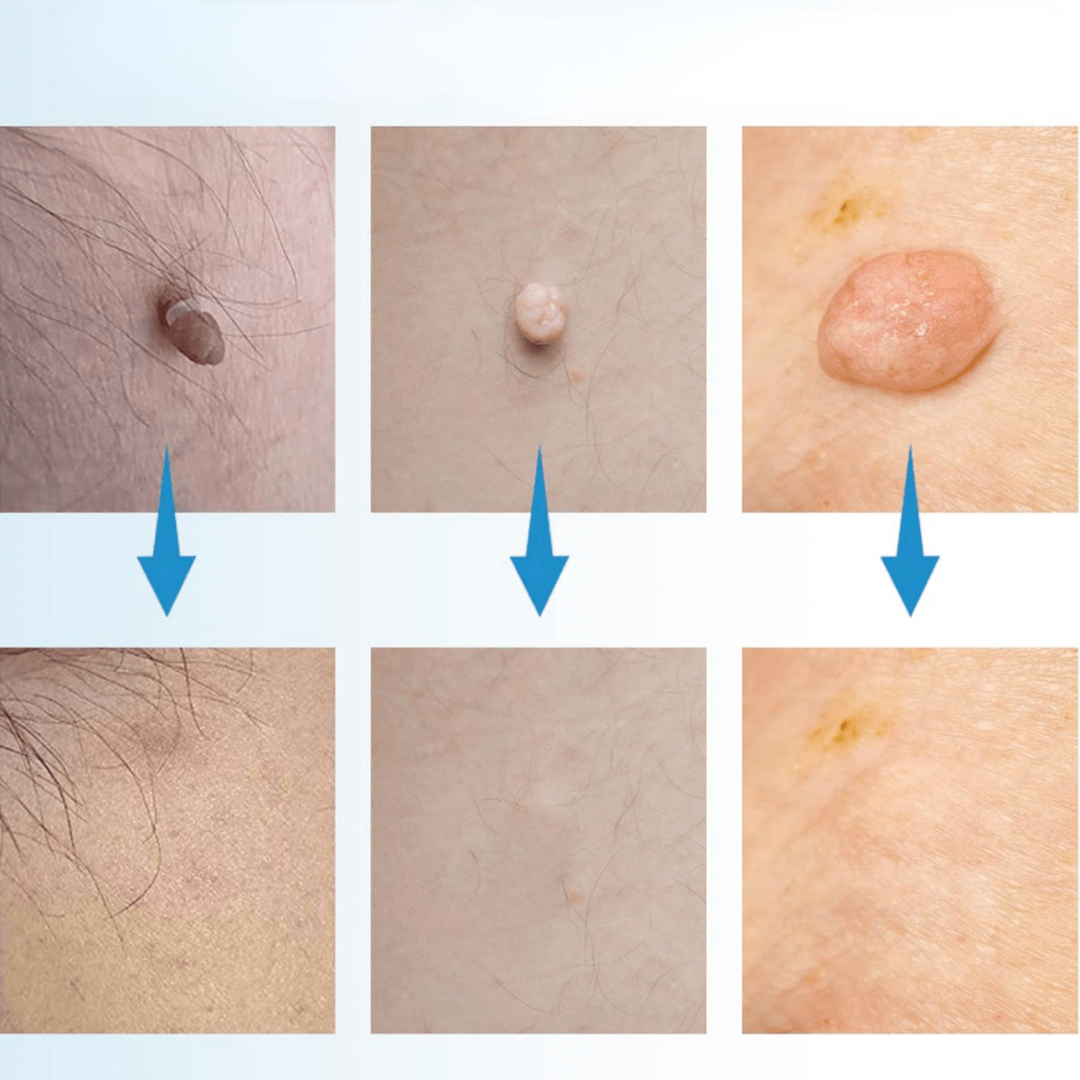 BowLift | WartAway – Remove warts, completely without chemicals!