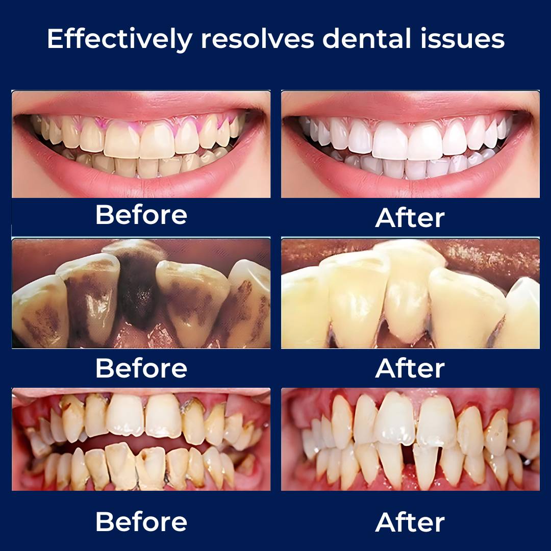 PlaqueFree Plaque Remover for teeth | Ultrasonic Teeth Cleaner - Tartar Remover from Home - Deep Teeth Cleaning and Polish Bowlift