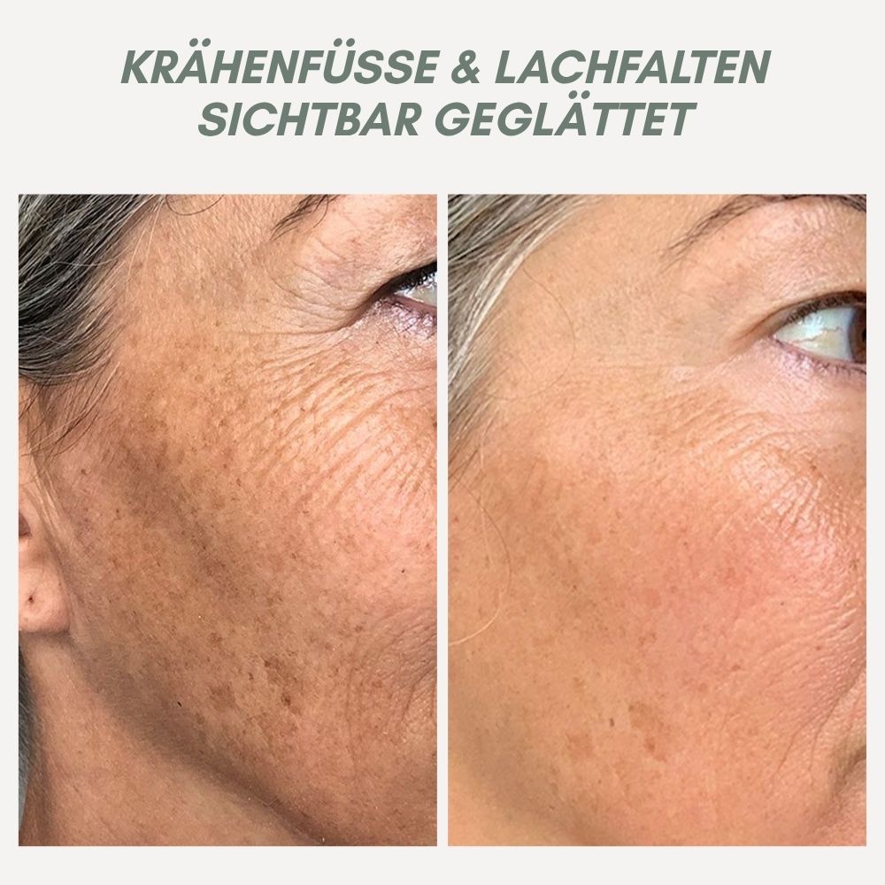BowLift | YouthMorph — Tight skin in minutes for your youthful WOW moment