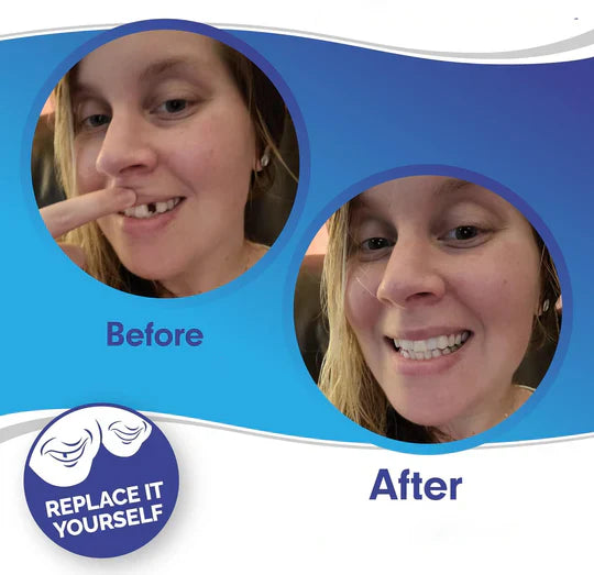 BowLift | Smile Veneer (Upper & Lower Included)
