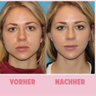 BowLift | SlimSuction Defined Jawline Boost