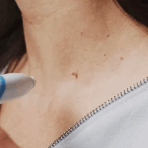 BowLift | SmoothZap — Pain-free skin freedom for a new sense of confidence in just 10 days