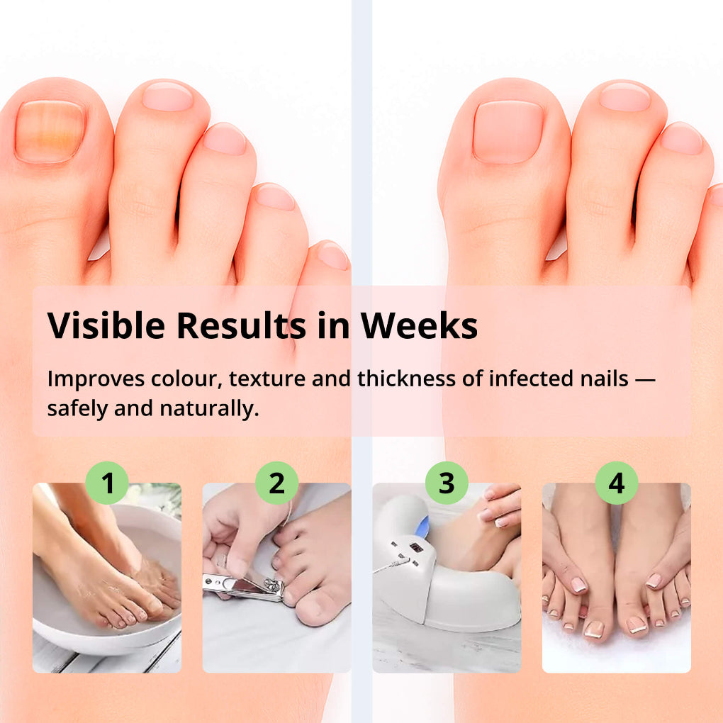 Laser Nail Treatment Device – Red and blue light against nail fungus | Bowlift