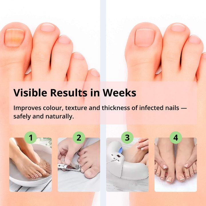 BowLift | Laser Nail Treatment Device – Red and blue light against fungal nails