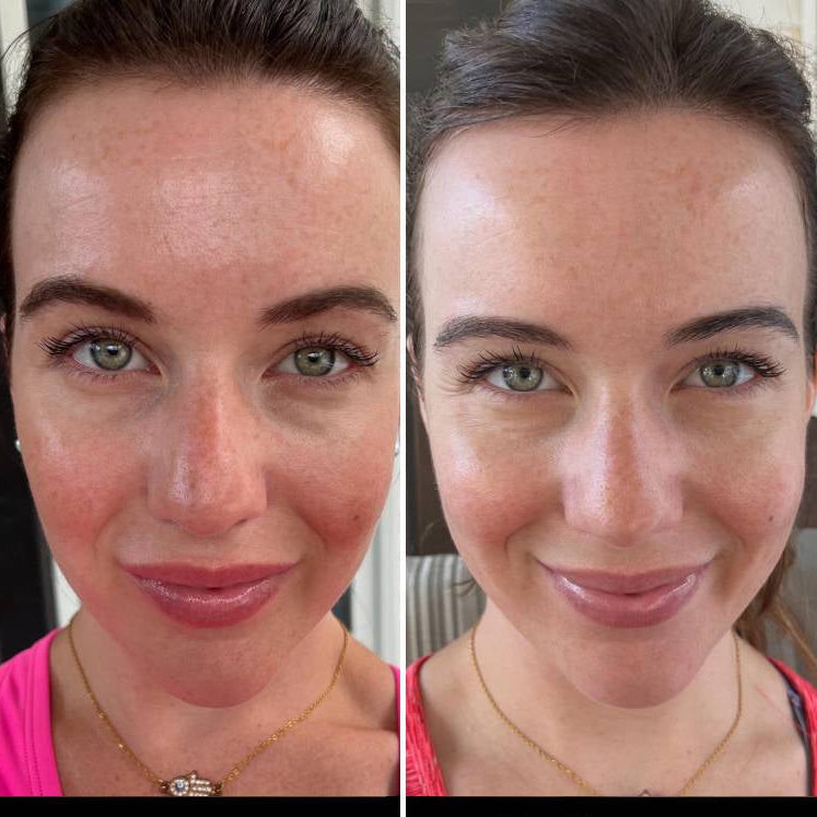 BowLift | LED Face Mask Light Therapy Skincare Device