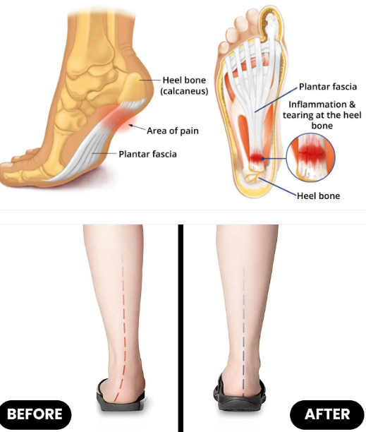 Orthopedic Insole | Soft, Supportive, Breathable | Bowlift