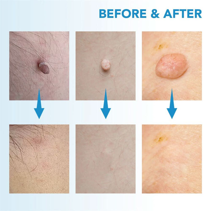 BowLift | Skin spot remover for warts & skin tags