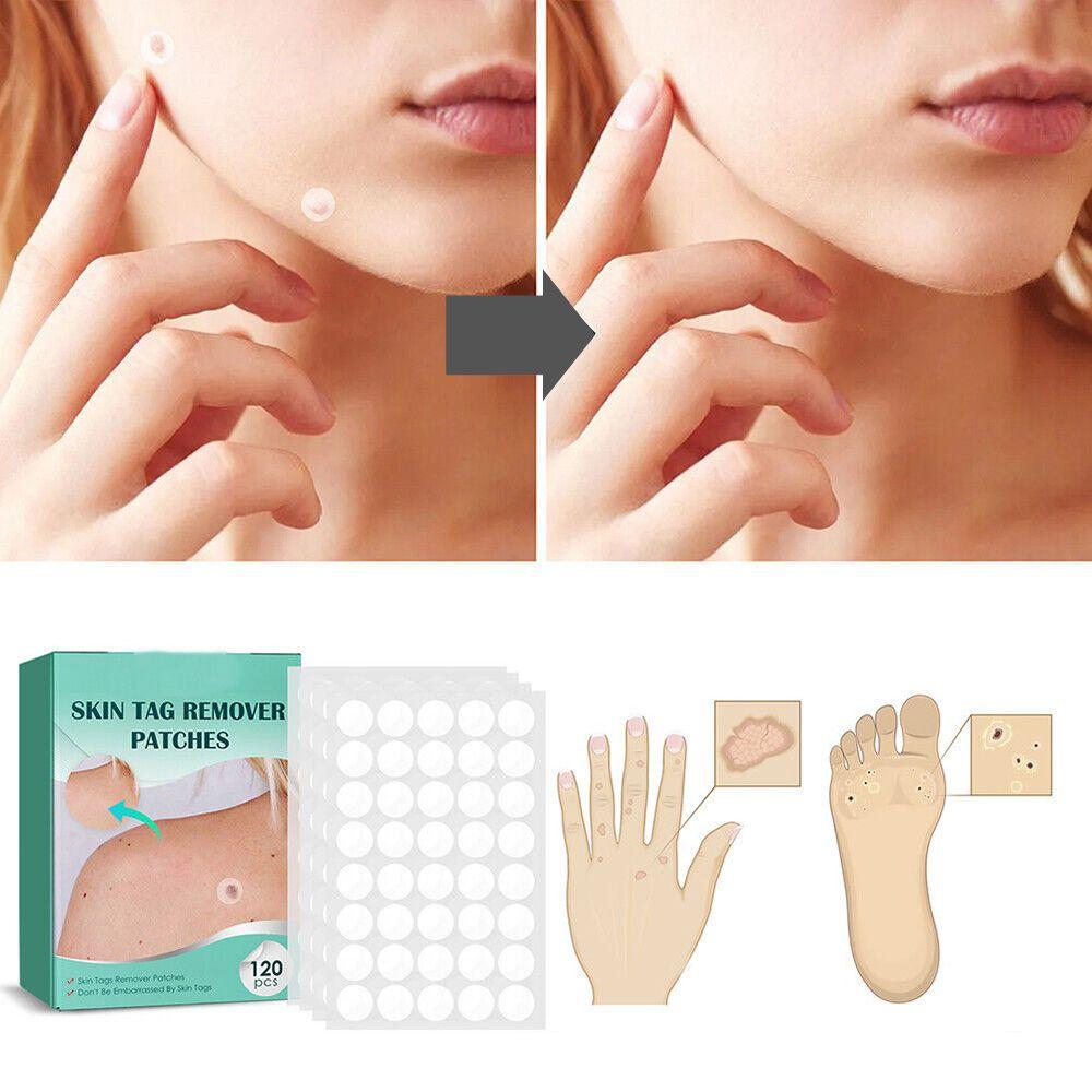 SkinClear - Patch for the removal of spots and warts Bowlift
