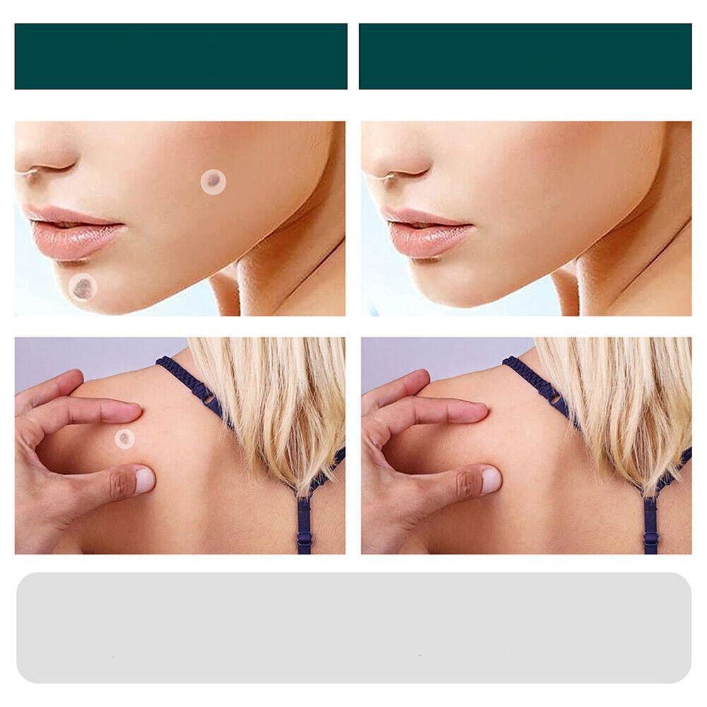 SkinClear - Patch for the removal of spots and warts Bowlift