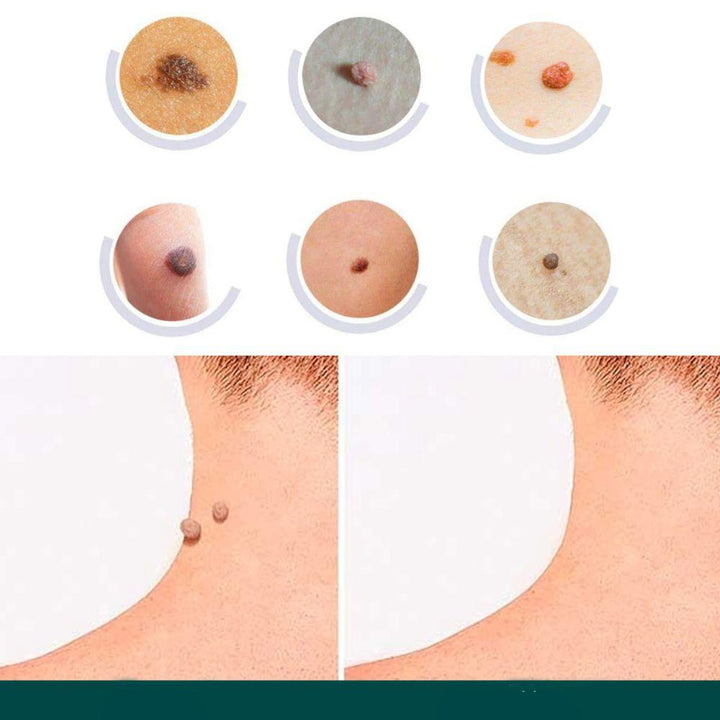 SkinClear - Patch for the removal of spots and warts Bowlift