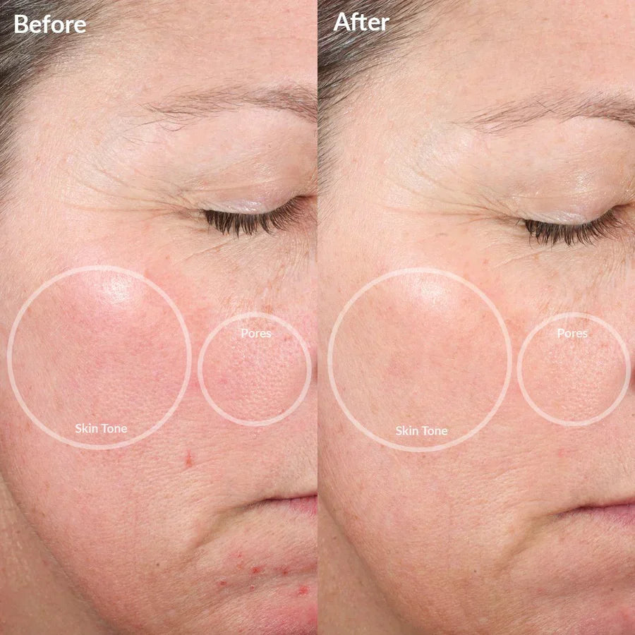BowLift | 4-in-1 Lumi Lift - improve your skin in 2 days with LED and EMS light therapy