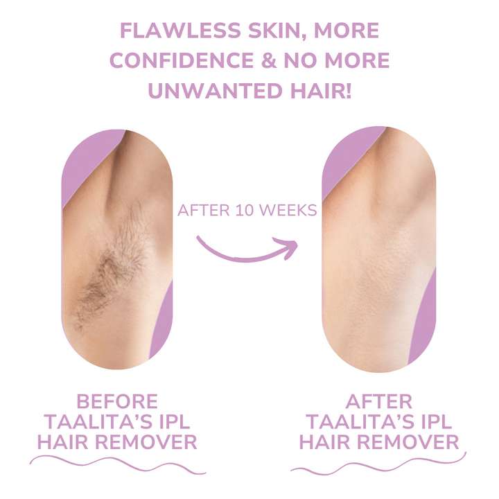 BowLift | SoftLight IPL Hair Removal Device – Pain-Free Home Hair Removal