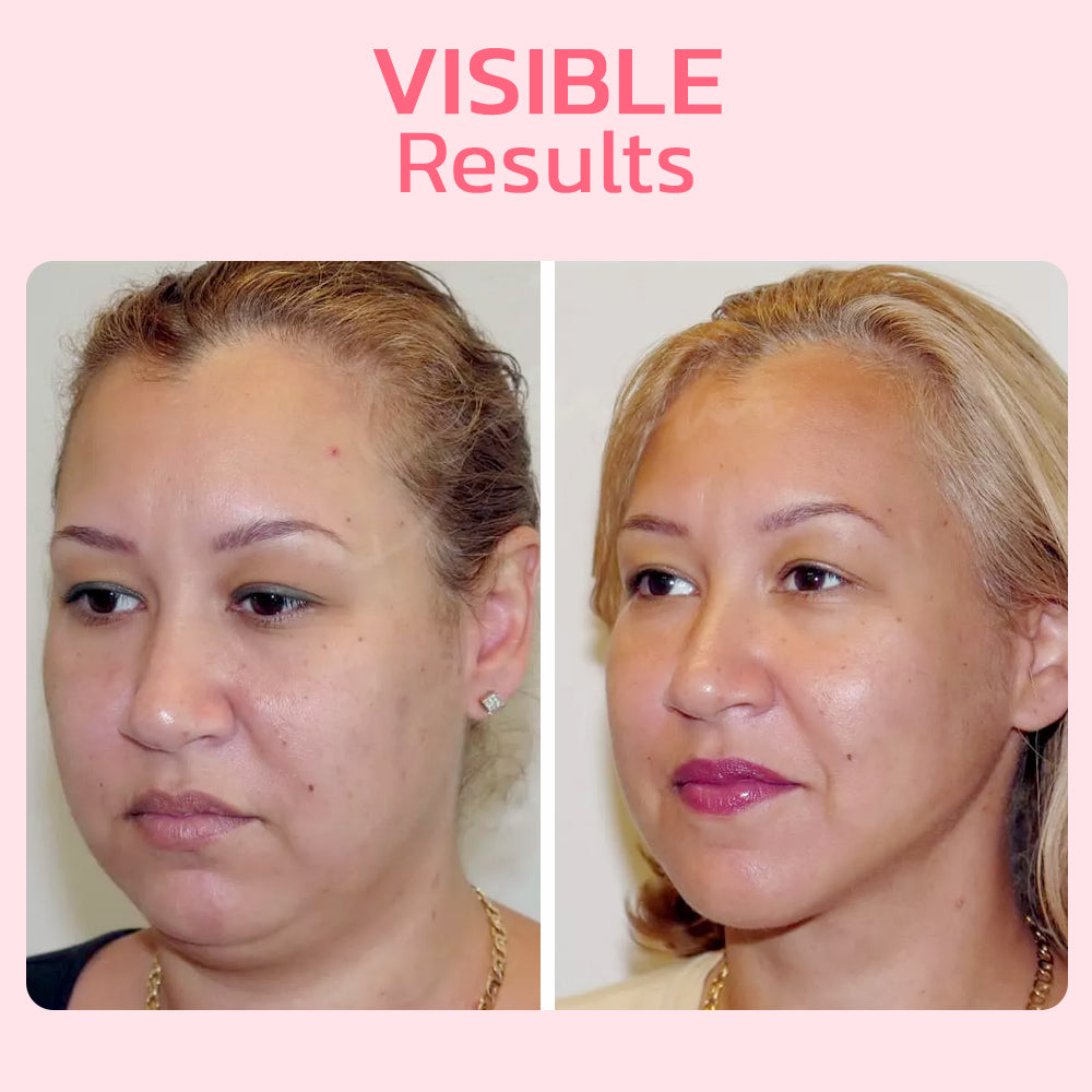 BowLift | FaceSuction Enhanced Facial Definition