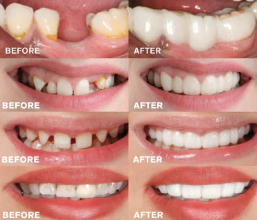BowLift |  - Snap-in Dental Prosthesis | 1+1 FREE!
