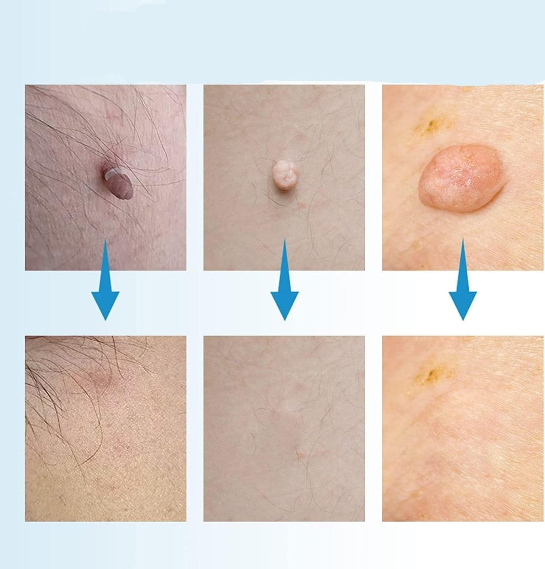 BowLift | EPICLEAR – At-Home Skin Tag & Wart Remover Kit