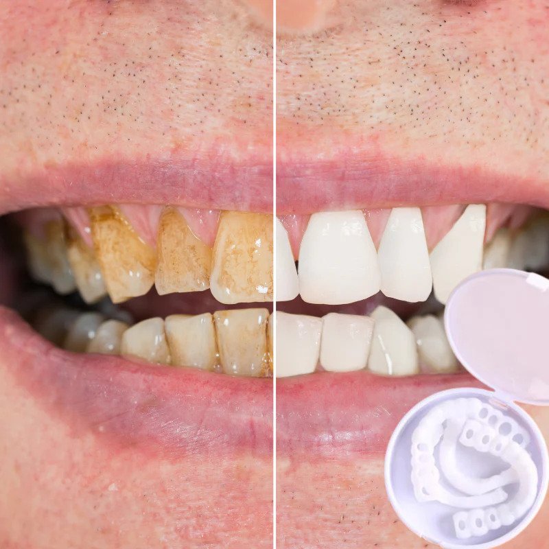 BowLift | Snap-on Teeth™ - With these veneers, always have the perfect smile