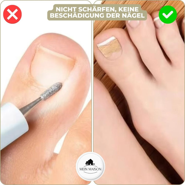 BowLift | ALIGNSTRIP – Painless Nail Correction Strips for Ingrown & Deformed Nails