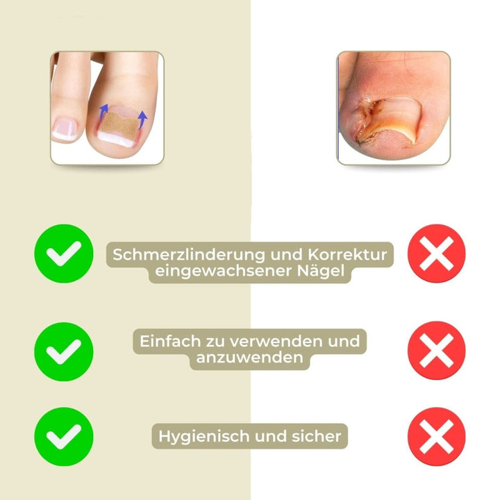 BowLift | ALIGNSTRIP – Painless Nail Correction Strips for Ingrown & Deformed Nails