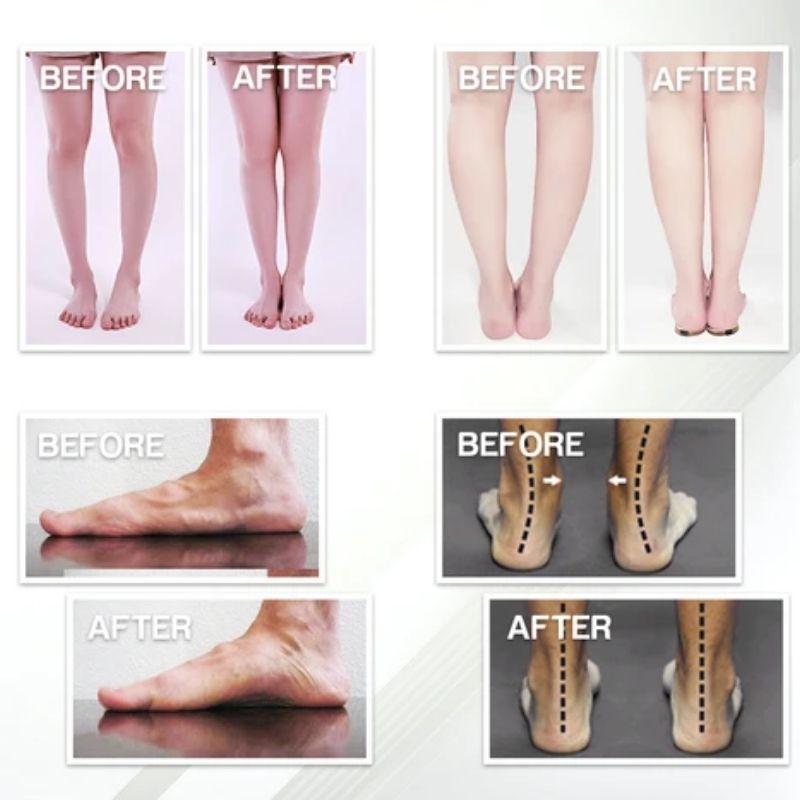BowLift | Flat Foot Orthopedic Insoles