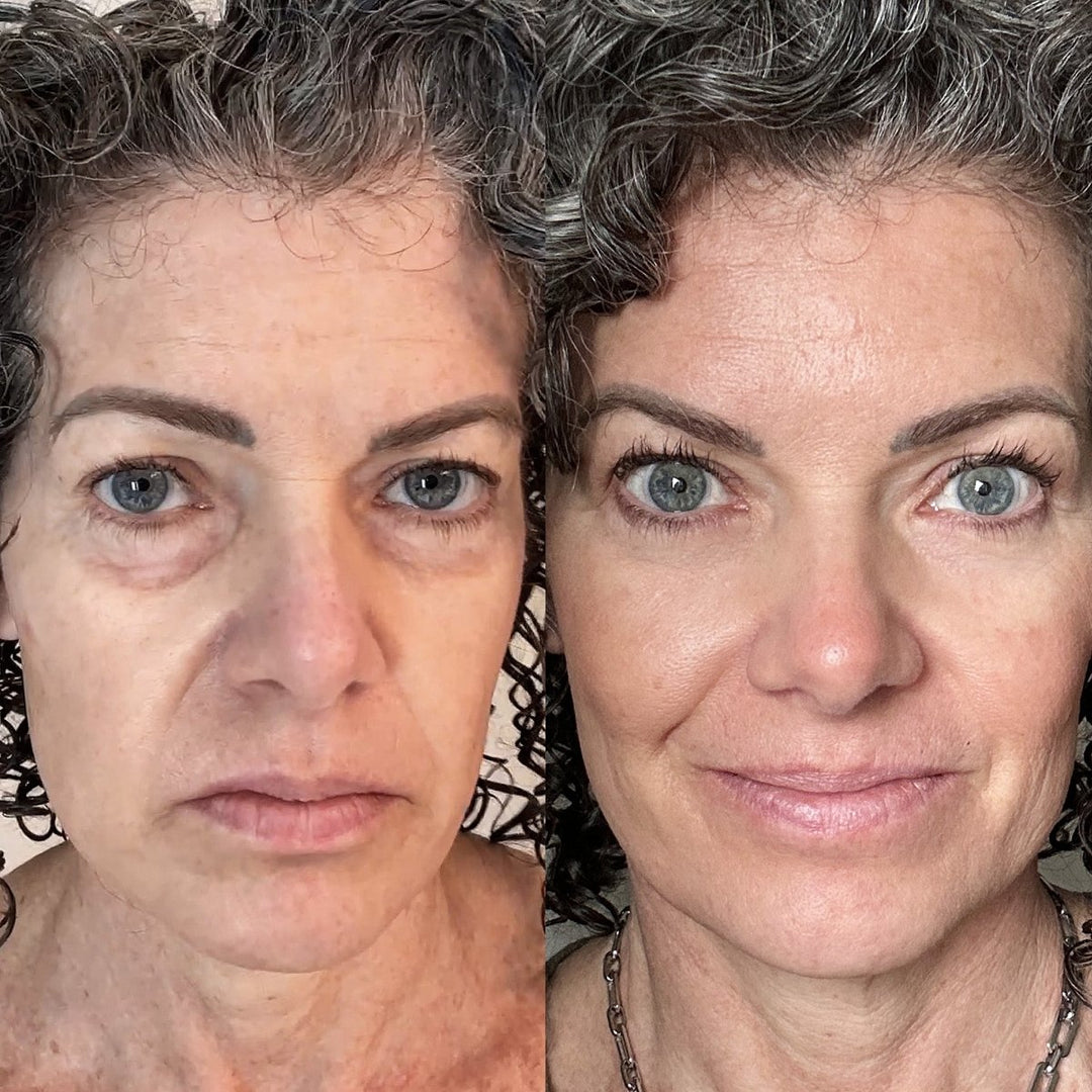 BowLift | EyeRevive | Radiance and freshness regained