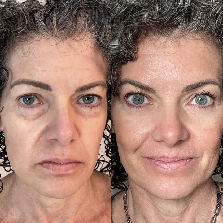 BowLift | EyeRevive | Radiance and freshness regained