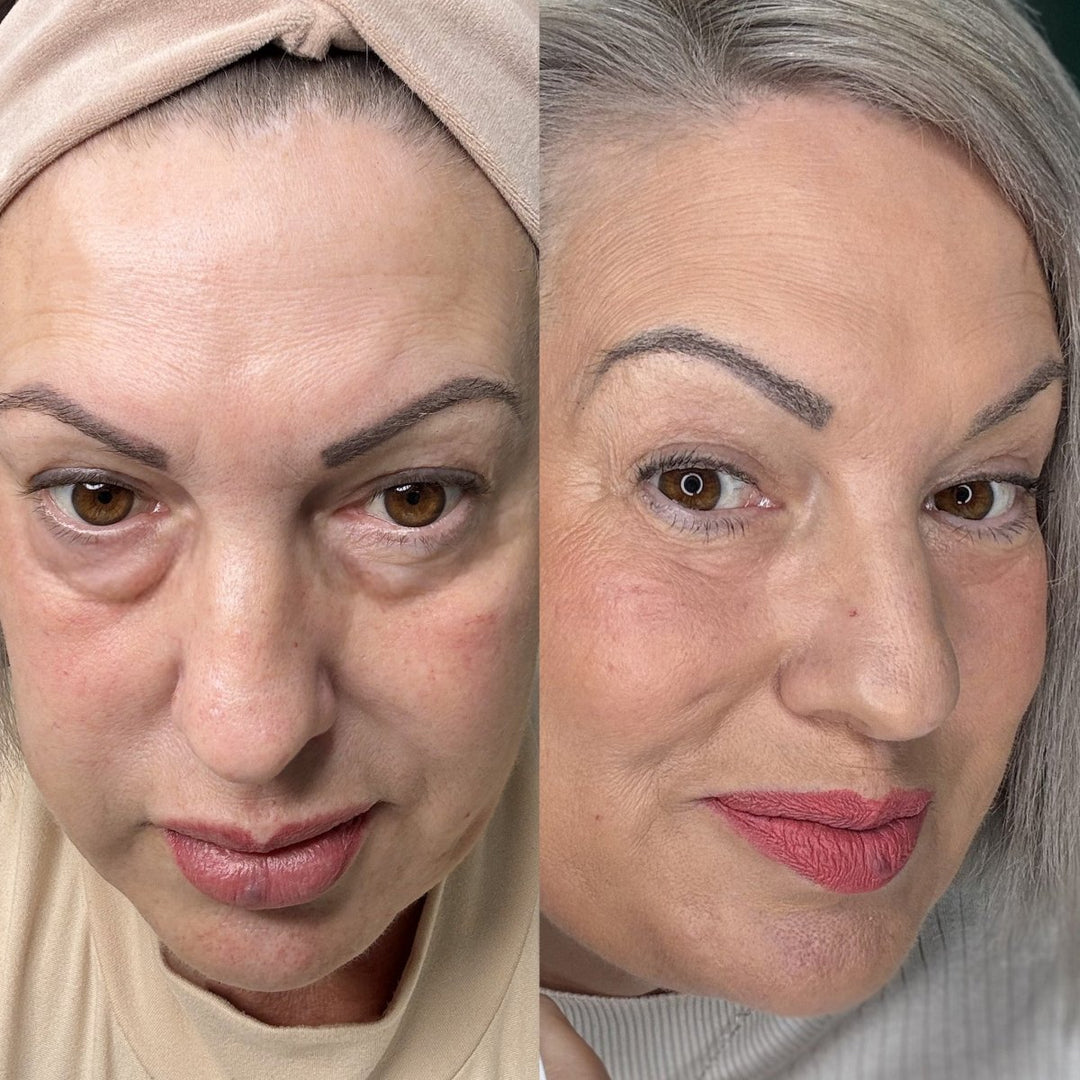 BowLift | EyeRevive | Radiance and freshness regained