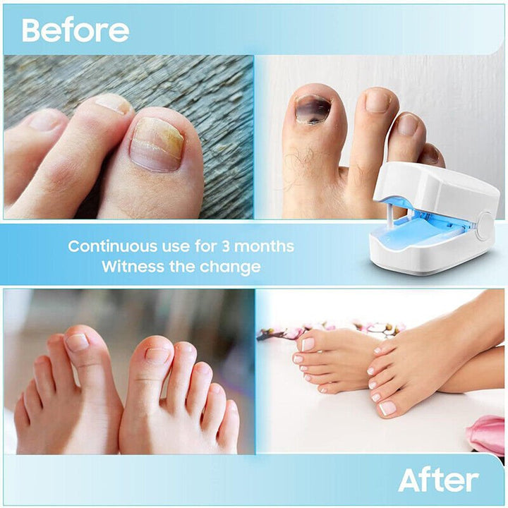 BowLift | Laser device for nail fungus cleaning – Revolutionary, highly efficient light therapy device from Expert for toe nail conditions
