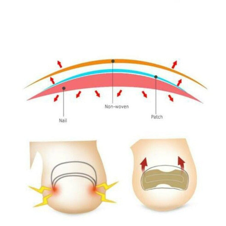 BowLift | Painless Toenail Patch - ToenailExpress™
