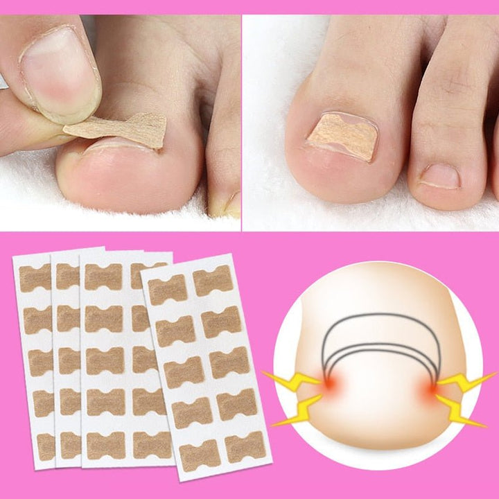 BowLift | Painless Toenail Patch - ToenailExpress™
