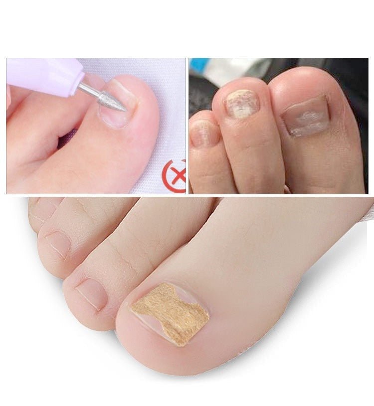 BowLift | Painless Toenail Patch - ToenailExpress™